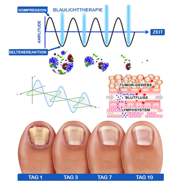 Furzero™ Nagelpilzreinigung Laser Linderungsgerät - Image 9