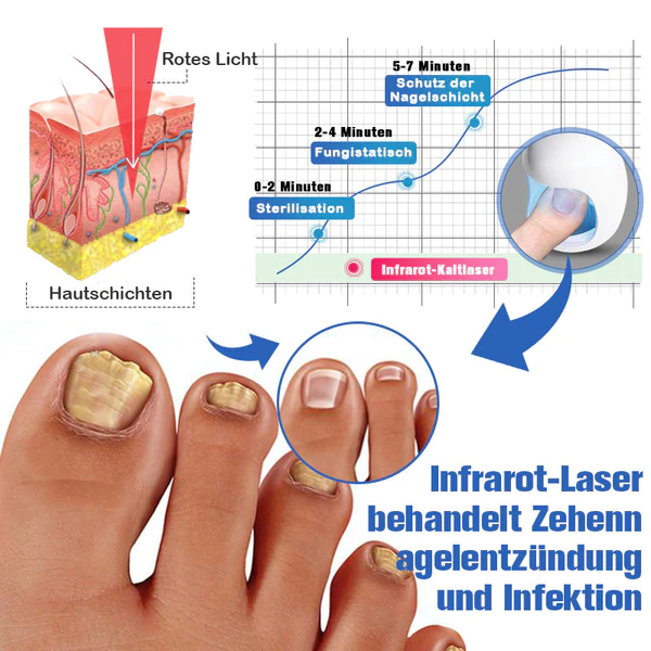 Furzero™ Nagelpilzreinigung Laser Linderungsgerät - Image 7