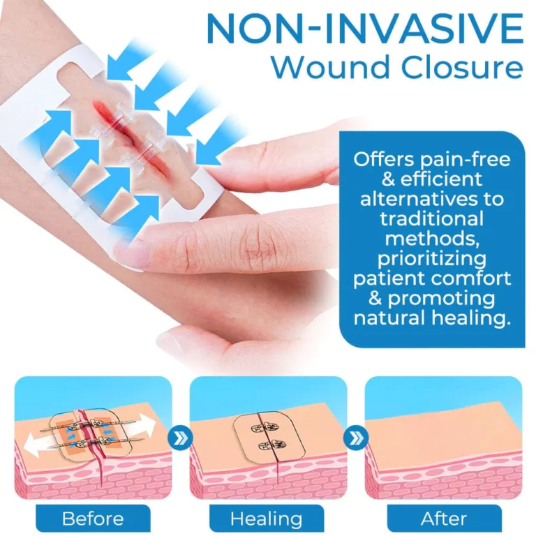 GFOUK™ StitchFree Closure Device - Image 8