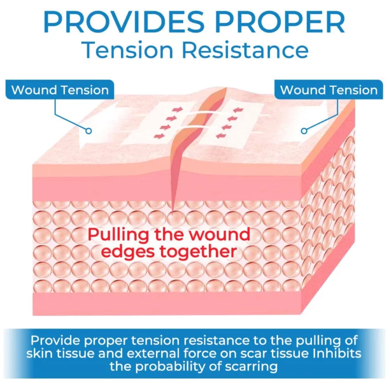GFOUK™ StitchFree Closure Device - Image 6