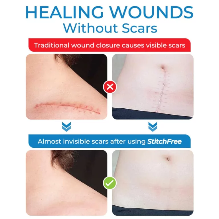 GFOUK™ StitchFree Closure Device - Image 5