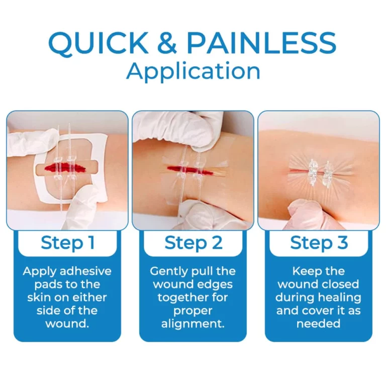 GFOUK™ StitchFree Closure Device - Image 3