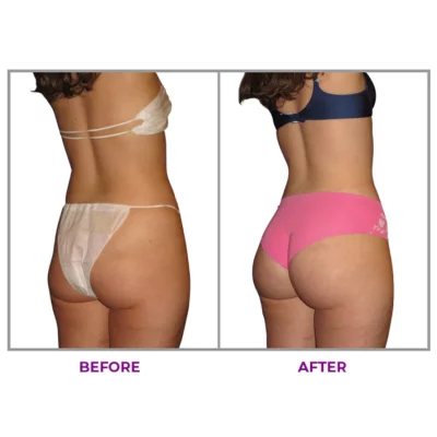 LIMETOW™ Hip Plump Capric Oil - Image 5