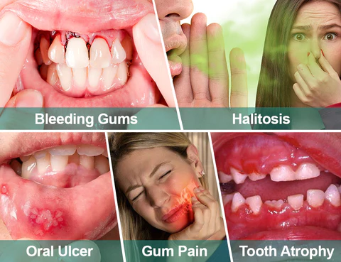 Furzero™ Herbal Mouth Spray - Image 7