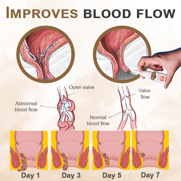 Calmez™ Hemorrhoids Treatment Spray - Image 4