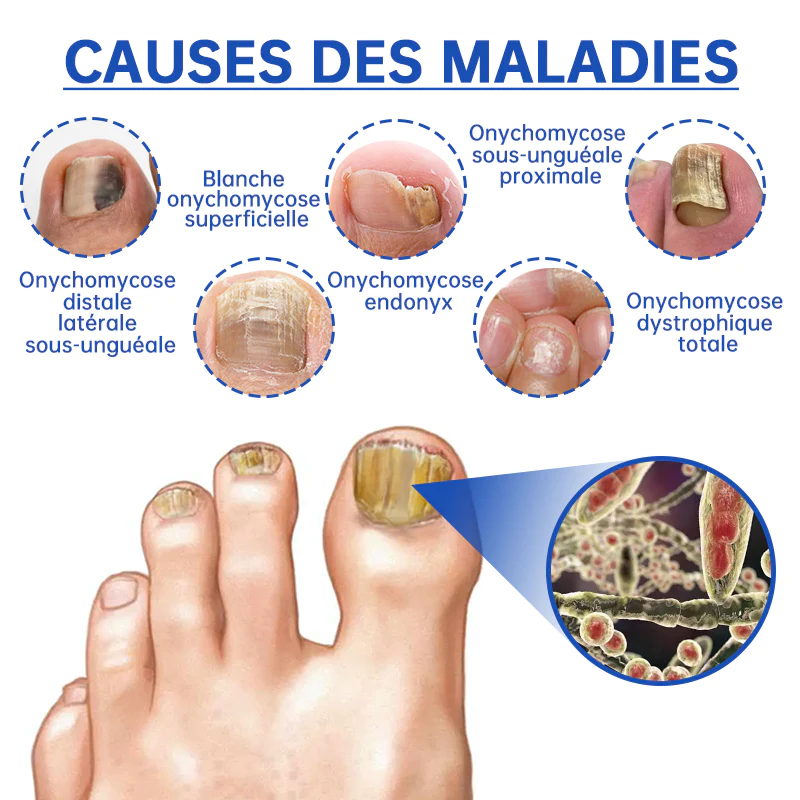 Furzero™ Le Dispositif de Thérapie Laser Antifongique - Image 7
