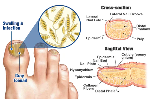 Furzero™ Herbal Formula Fungal Nail Paronychia Treatment Gel - Image 4