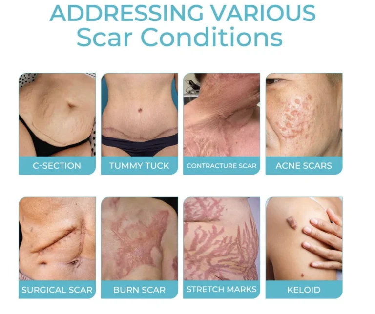 GFOUK™ Scafree Advanced Skin Spray - Image 5