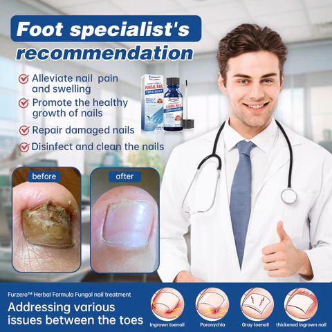 Furzero™ Herbal Formula Fungal Nail Paronychia Treatment Gel - Image 3