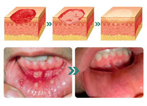 Furzero™ Herbal Mouth Spray - Image 5