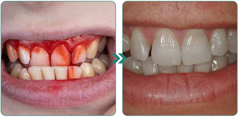 Furzero™ Herbal Mouth Spray - Image 4