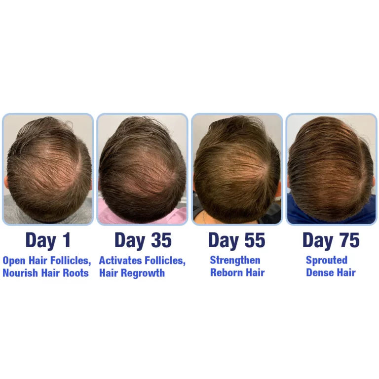 GFOUK™ PotentGRO Hair Treatment Roller - Image 6