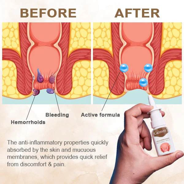 Calmez™ Hemorrhoids Treatment Spray - Image 3