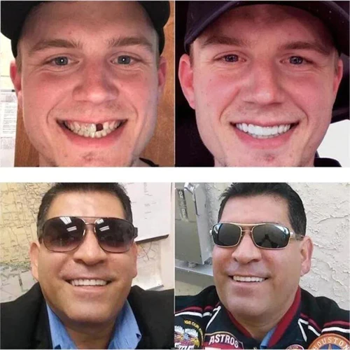 Oveallgo™ Prothèses ajustables à clipser - Image 3