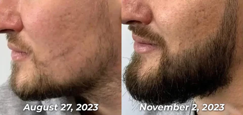 GFOUK™ PotentGRO Hair Treatment Roller - Image 4