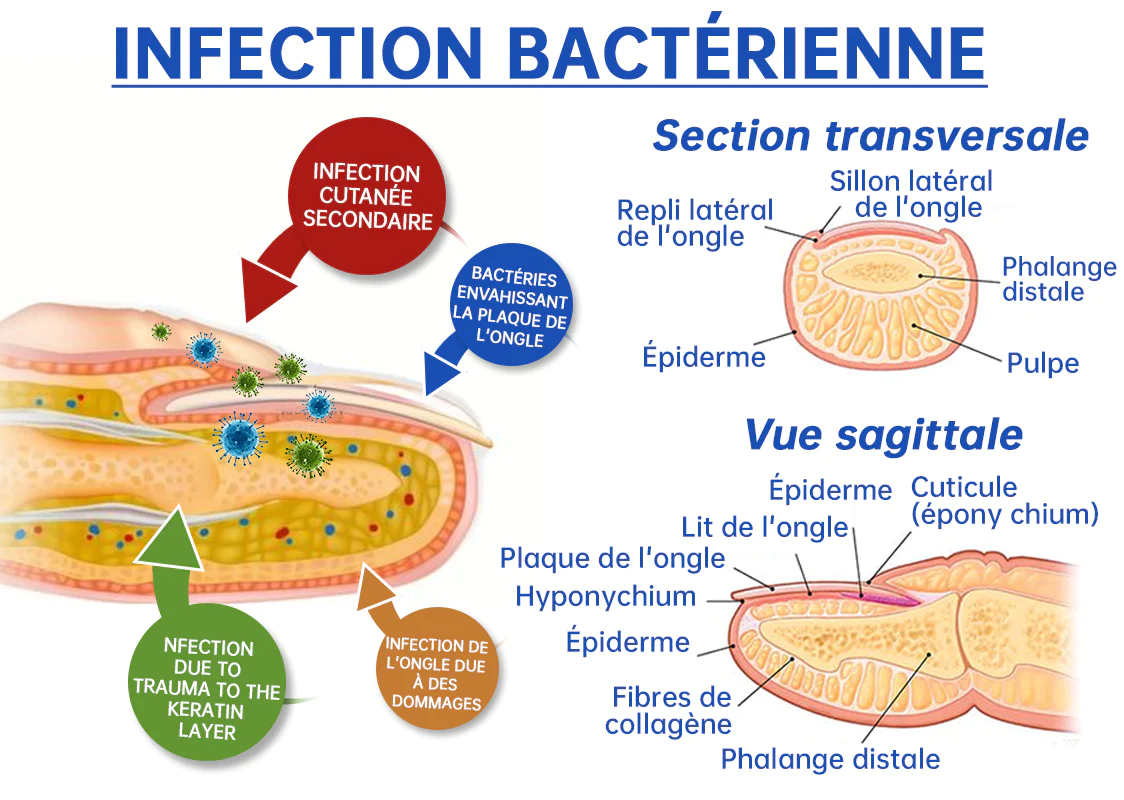 Furzero™ Le Dispositif de Thérapie Laser Antifongique - Image 4