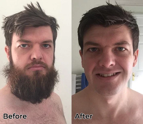 Fivfivgo™ Laser-Haarentferner - Image 9