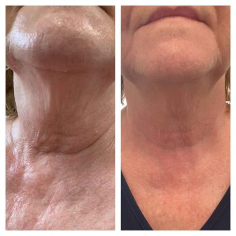 LIMETOW™ Lymphogermane Earrings - Image 4