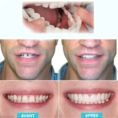 Oveallgo™ Prothèses ajustables à clipser - Image 4