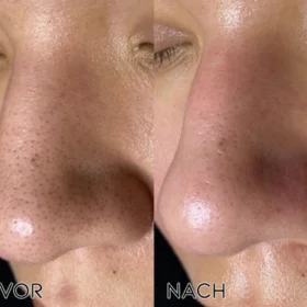 Fivfivgo™ Ultraschall-Porenabsauger BlackheadRemover PoreVacuum - Image 6