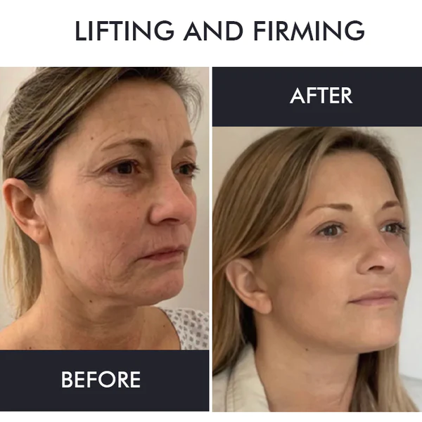 Oveallgo™ Korean Gold Seal Lifting Cream+ 2-in-1 Red Light / EMS Therapy Device SET - Image 6