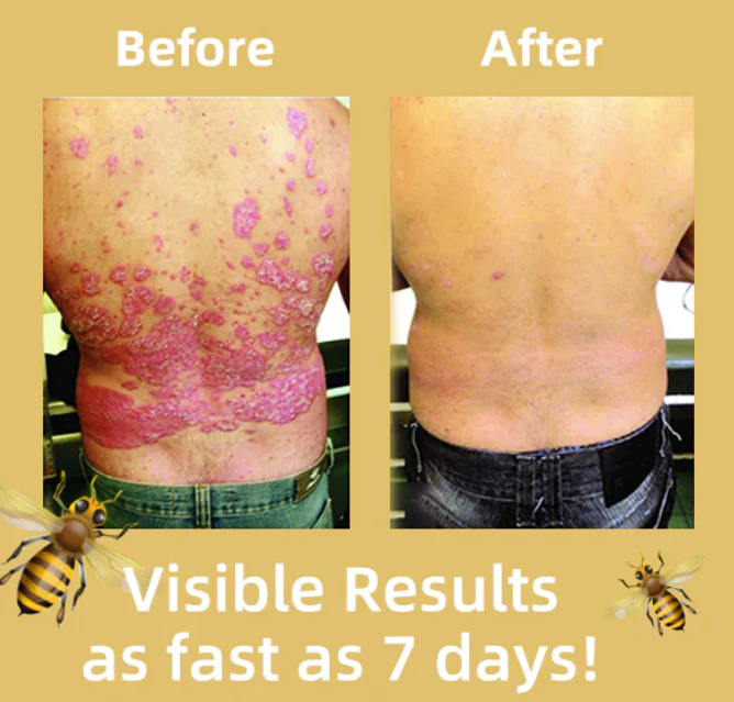 Fivfivgo™ BeeVenom Psoriasis-Lösungs-Creme - Image 5
