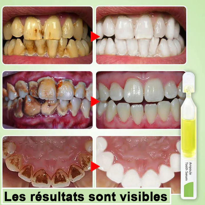 Sérum de blanchiment des dents éliminer les taches et blanchir les dents - Image 7