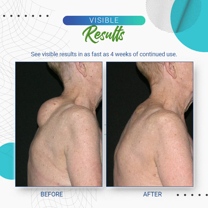 Cvreoz™Lipoma Removal Cream - Image 14