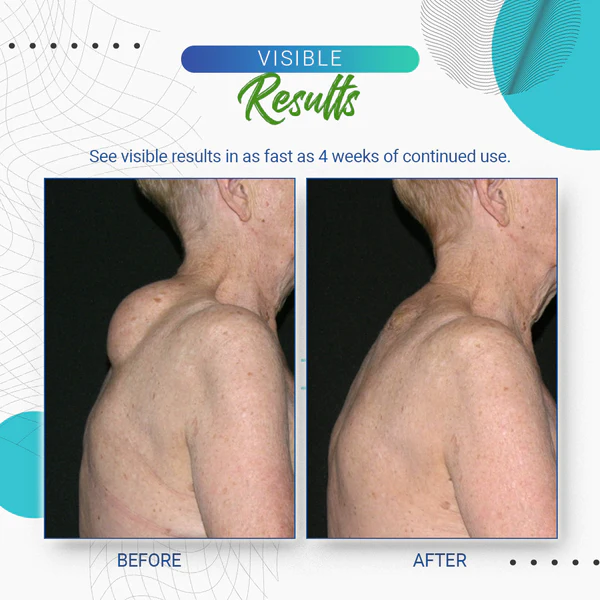 Dobshow™ Lipoma Removal Cream - Image 13