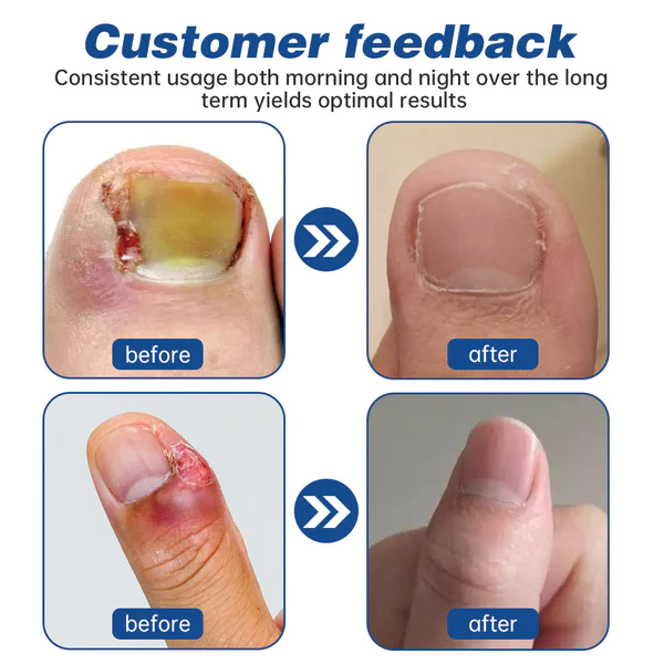 Dobshow™ Herbal Formula Fungal nail Paronychia treatment Gel - Image 8