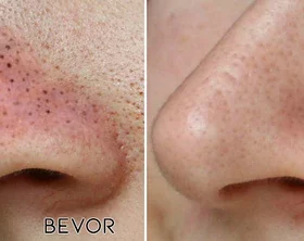 Fivfivgo™ Ultraschall-Porenabsauger BlackheadRemover PoreVacuum - Image 7