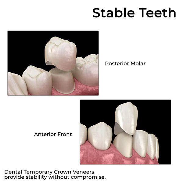 Oveallgo™ Dental Temporary Crown Veneers - Image 7