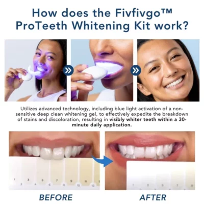 Oveallgo™ ProTeeth Whitening Kit - Image 5