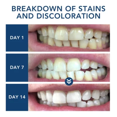 Oveallgo™ ProTeeth Whitening Kit - Image 3