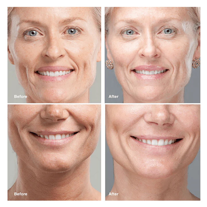 BEAUTE™ PROTEIN THREADING SET - Image 13