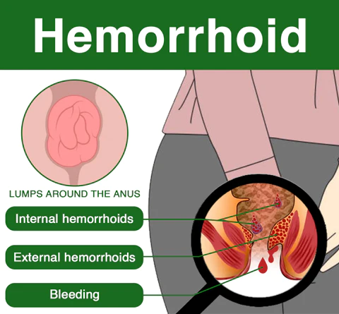 Kisshi™ Hemorrhoid Spray - Image 7