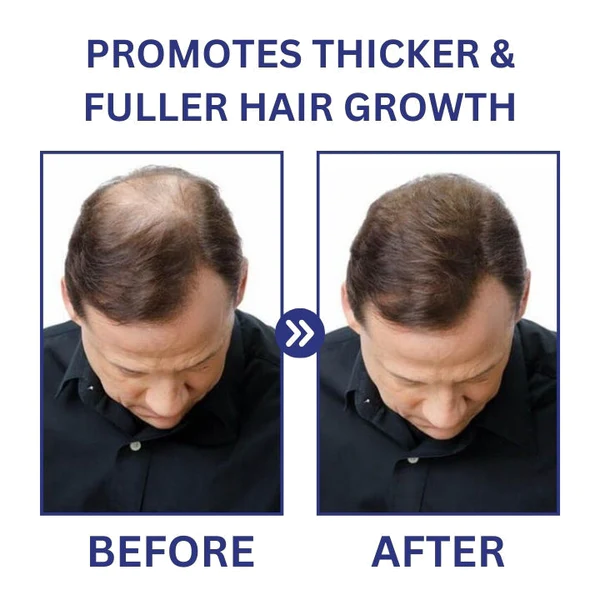 Fivfivgo™ PotentGRO Hair Treatment Roller - Image 4