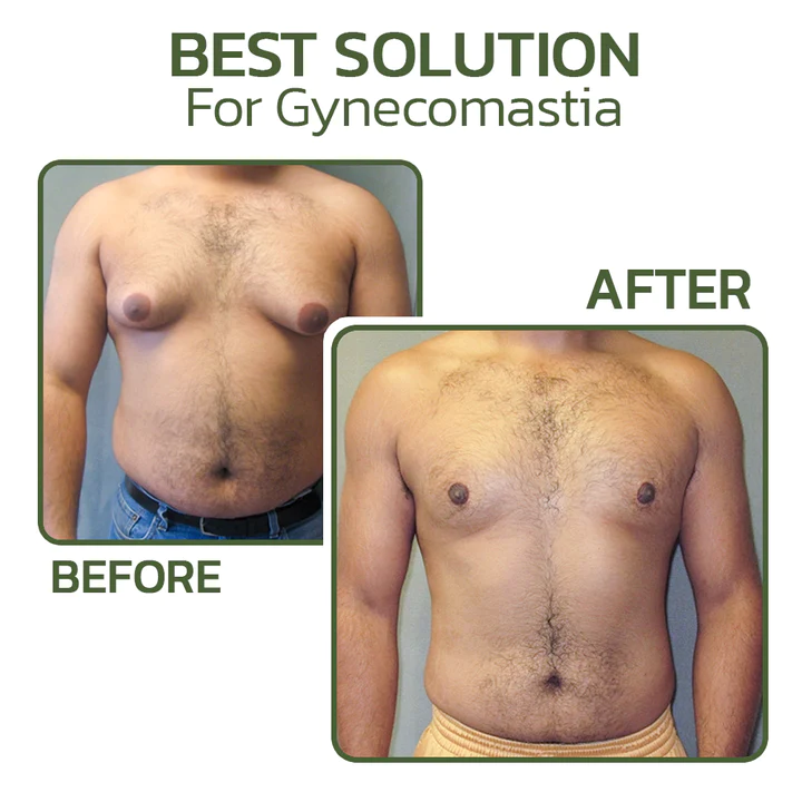 GFOUK™ CurcuminPlus Gynecomastia Compress Patch - Image 7