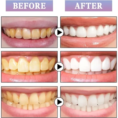 UNPREE™ NiceSmile Zahnaufhellungsessenz - Image 6