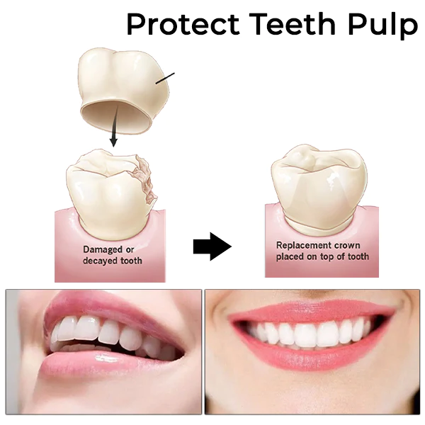 Oveallgo™ Dental Temporary Crown Veneers - Image 5