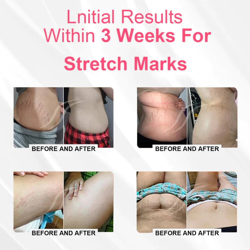 EXPECTSKY™ Negative Oxygen Ion Fat Burning Tummy Control & Detox Bodysuit - Image 10