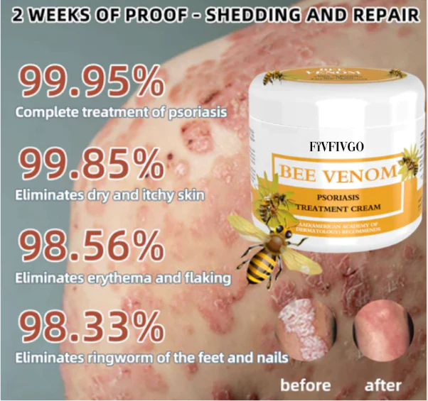 Fivfivgo™ BeeVenom Psoriasis-Lösungs-Creme - Image 4