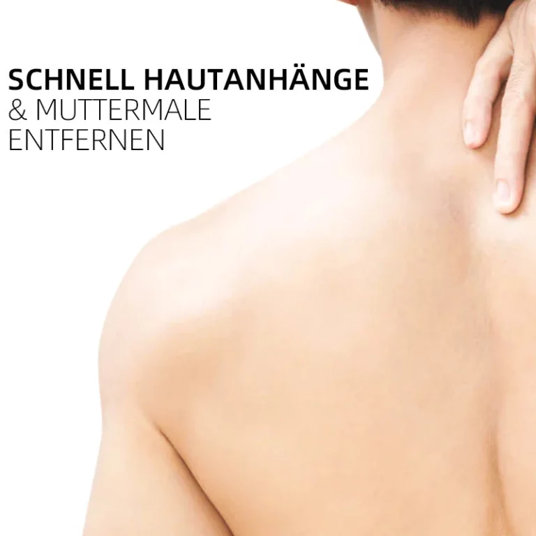 Ourlyard™ Biene Venom Wart und Tags Entfernung Behandlung Spray - Image 6