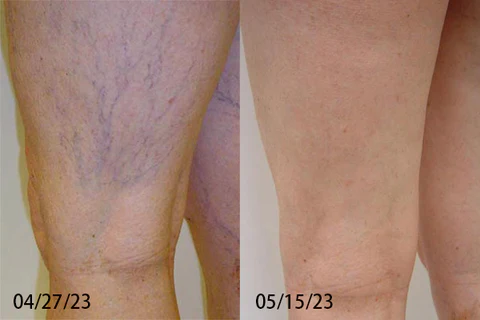 Furzero™ Bees Venom Varicose Veins Cream - Image 9