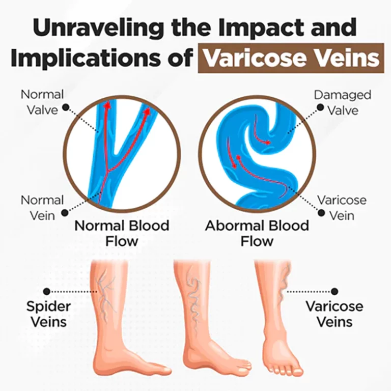 Furzero™ Bees Venom Varicose Veins Cream - Image 5