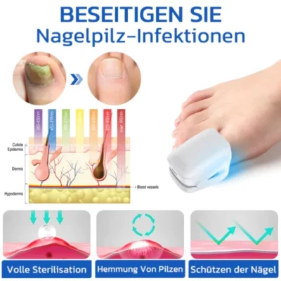GFOUK™ FungusOFF Nagellaser-Behandlungsgerät - Image 2