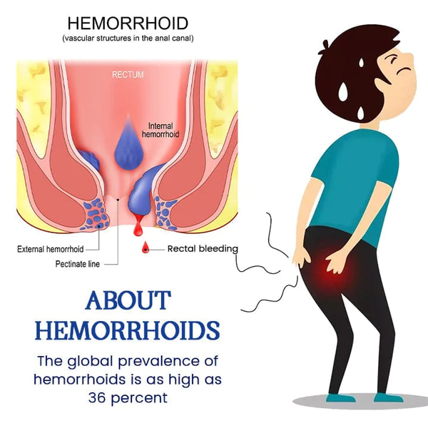 Biancat™ AnalEase Hemorrhoid Repair Herbal Capsules - Image 4