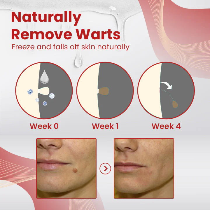 Ceoerty™ SkinClear Tags & Mole Remover - Image 8