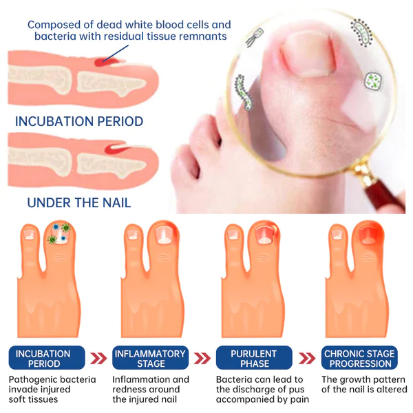 Dobshow™ Herbal Formula Fungal nail Paronychia treatment Gel - Image 10