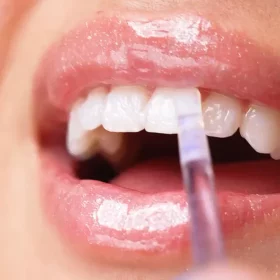 UNPREE™ NiceSmile Zahnaufhellungsessenz - Image 4